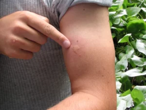 man pointing to a fresh mosquito bite - learn how to identify mosquito bites here