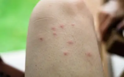 south carolina resident with multiple mosquito bites on their leg